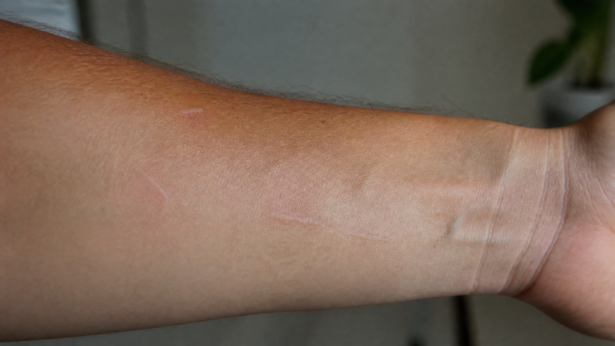 scars from repeated injections