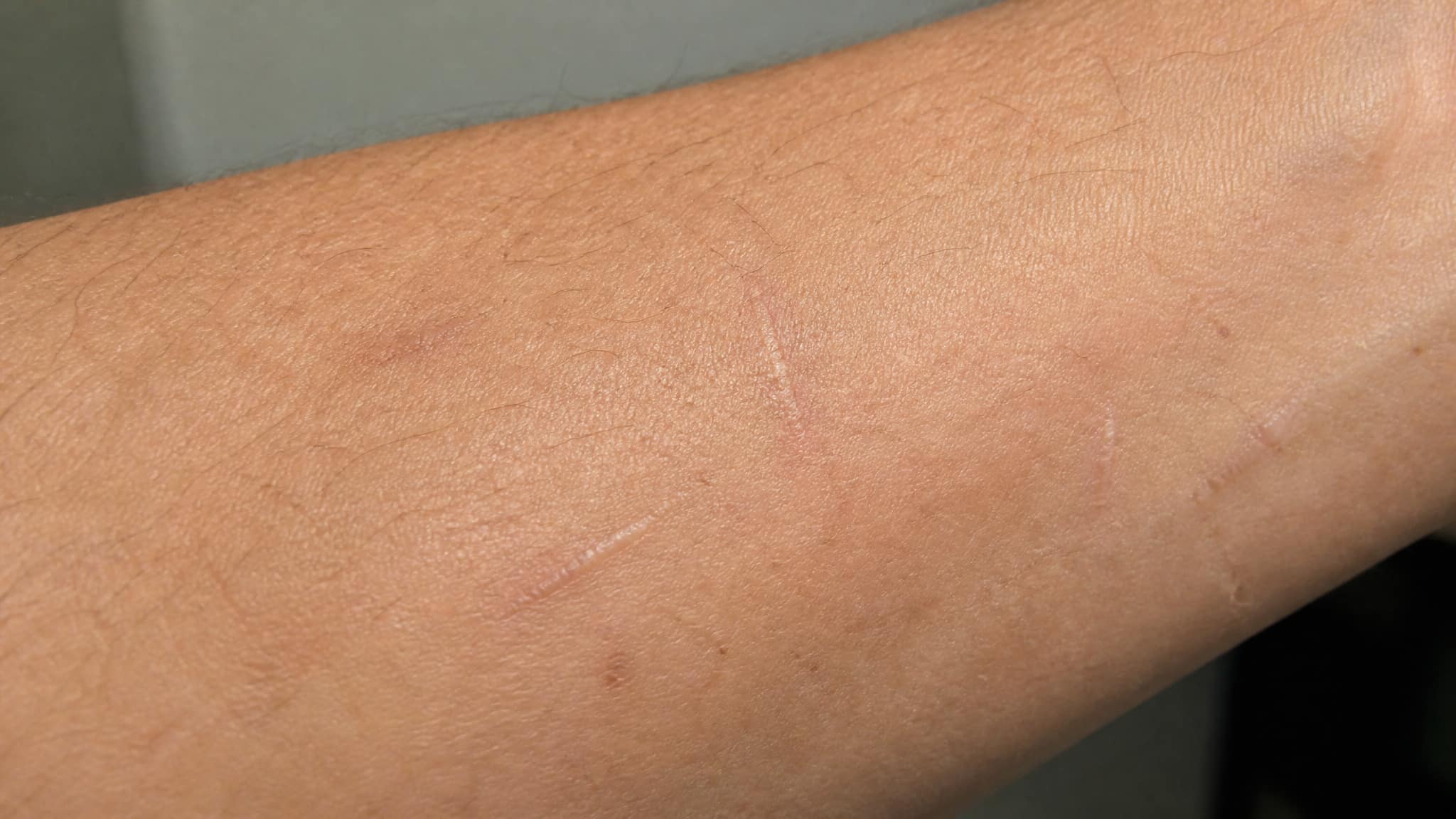 vein following injection marks